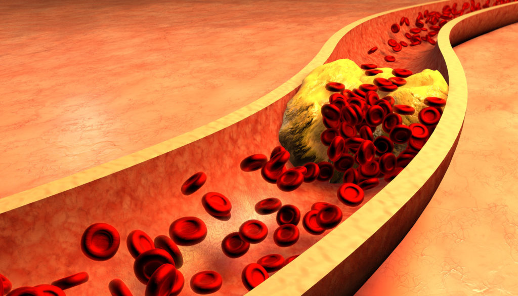 Peripheral Artery Disease (PAD) Medical Illustration Of Atherosclerosis Of The Lower Extremities