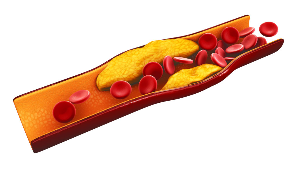 An Ankle-Brachial Index (ABI) Test Can Help Identify Peripheral Vascular Disease