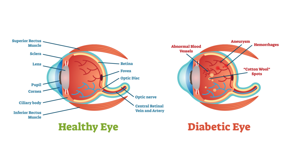 Diagram showing a healthy eye and an eye of a patient with diabetic retinopathy