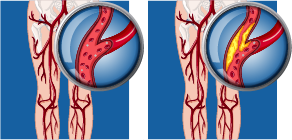 Peripheral Artery Disease diagram