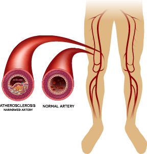 Picture of vascular disease in legs